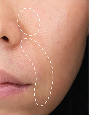 使用前肌膚狀況，細紋明顯、膚色不均